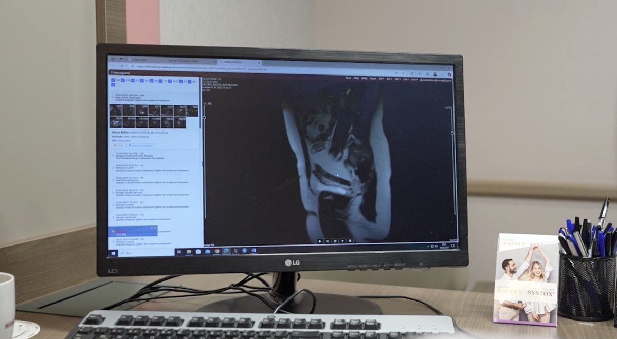 Endometriozis ve Çikolata Kisti: Erken Tanı ile Yaşam Kalitesi Üzerindeki Etkilerin Azaltılması